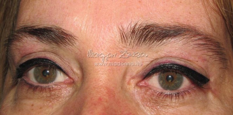 2015szemhejplasztika_esettanulmany4
