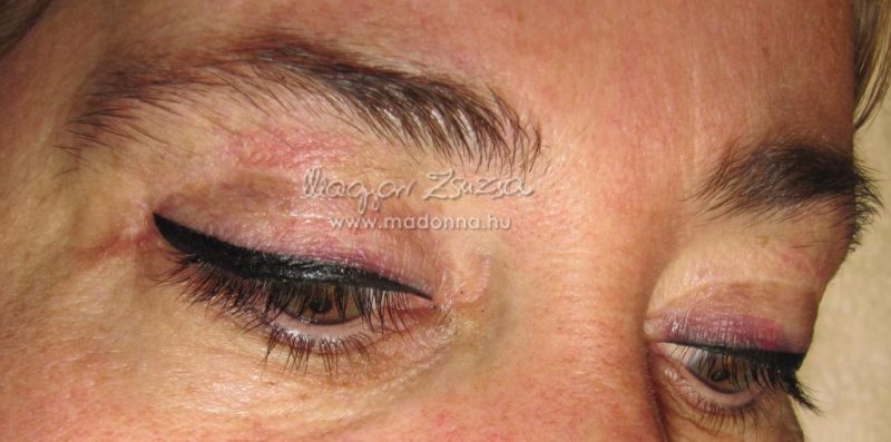 2015szemhejplasztika_esettanulmany6