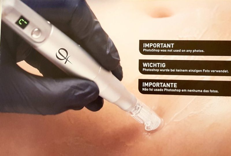 magyar_zsuzsa_microneedling_p